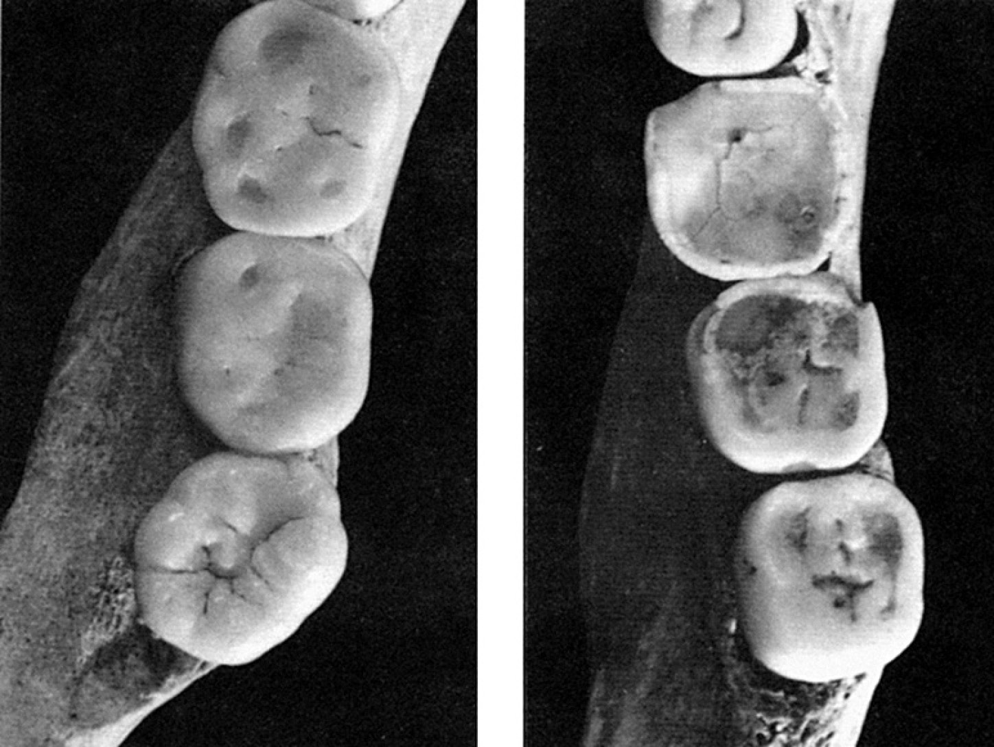 Fig. 4 –Wearonarchaeological tooth specimens (from ChaMBerlain 1994, figure 9p.18,used bypermission, © andrewChaMBerlain). See text for discussion of age estimates. On the left teeth conventionally aged at about 18 years, on the right at 40-50 years.