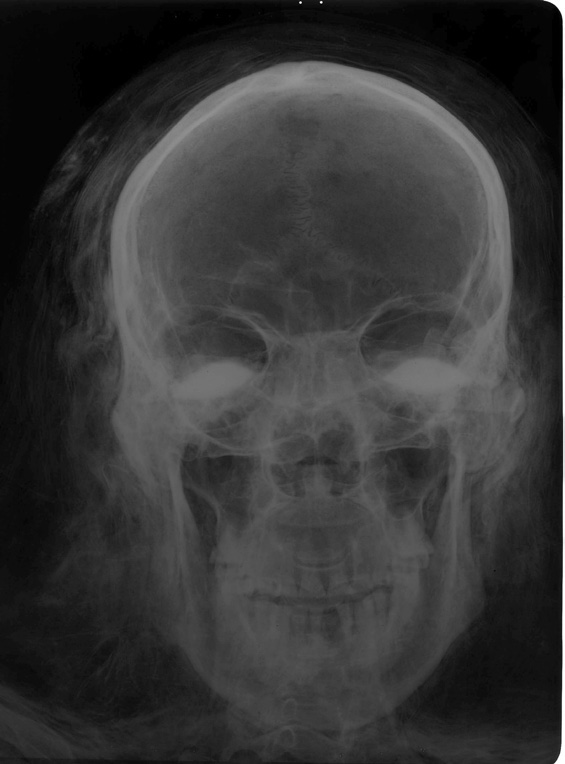 Fig. 9 – Cranio di mummia egizia con applicazioni in pasta vitrea nelle cavità oculari.